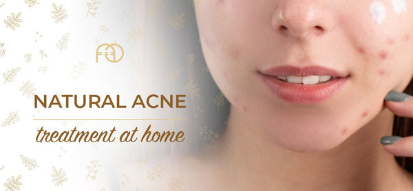 Natural Acne Treatment at Home