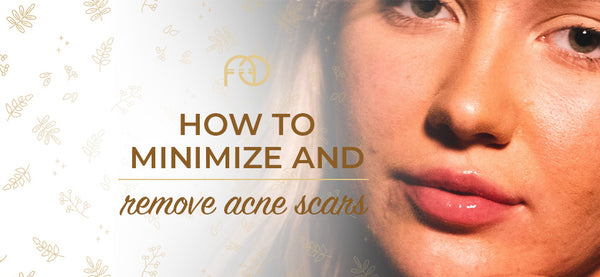 How to Minimize and Remove Acne Scars